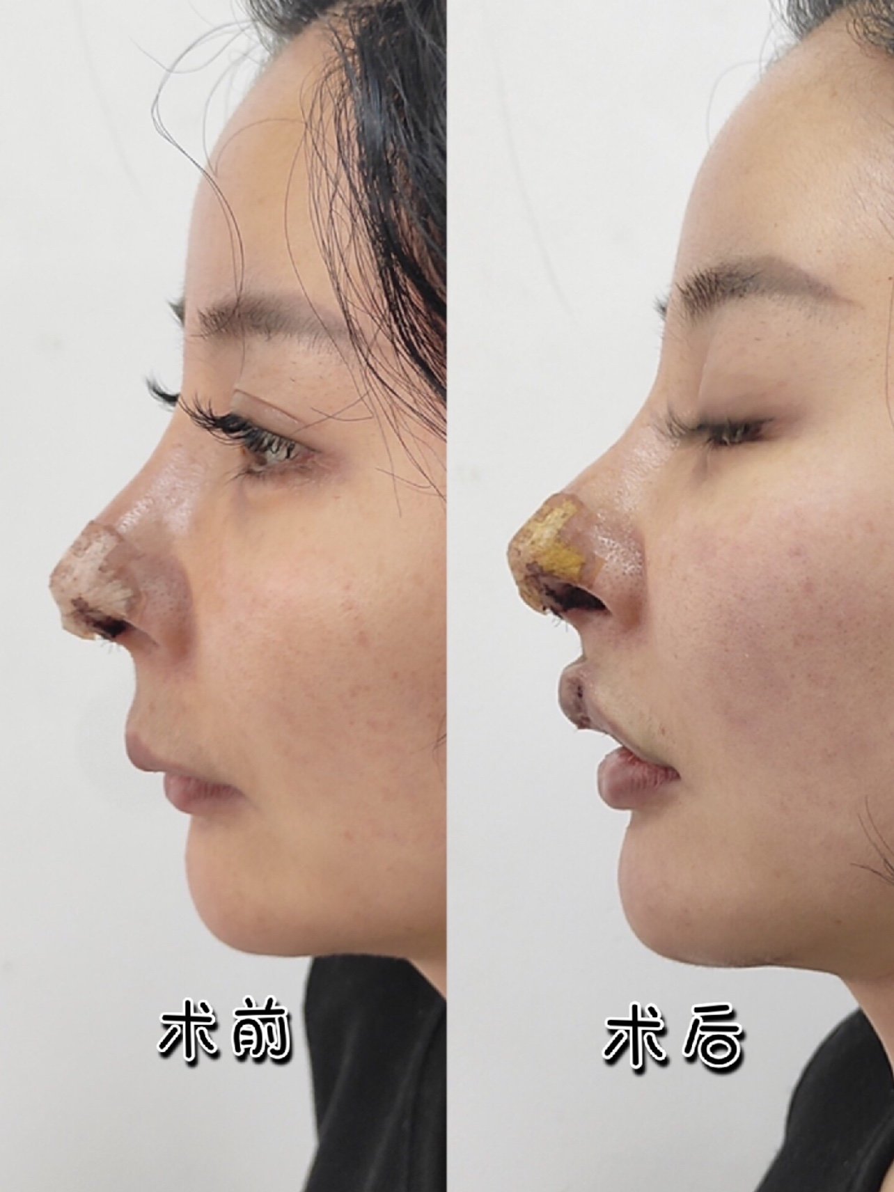缩短(缩短不应期)