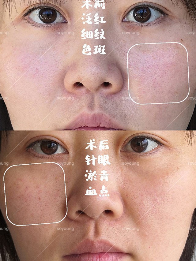 冭活泡泡针(冭活泡泡针功效)